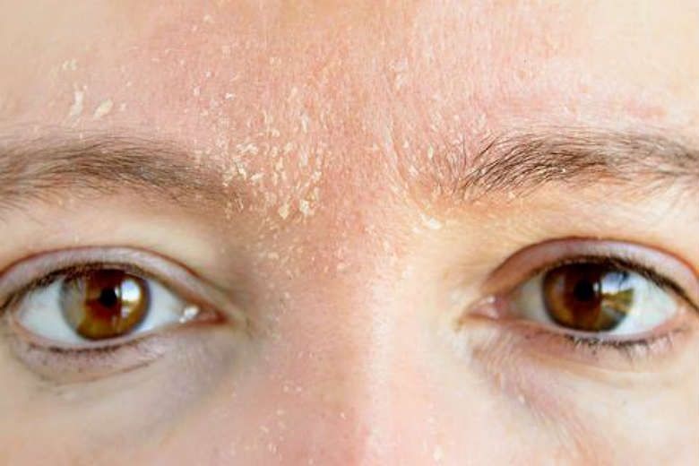 Dry Flaky Skin (Dandruff) Between Eyebrows Causes, Home Remedies & Treatment