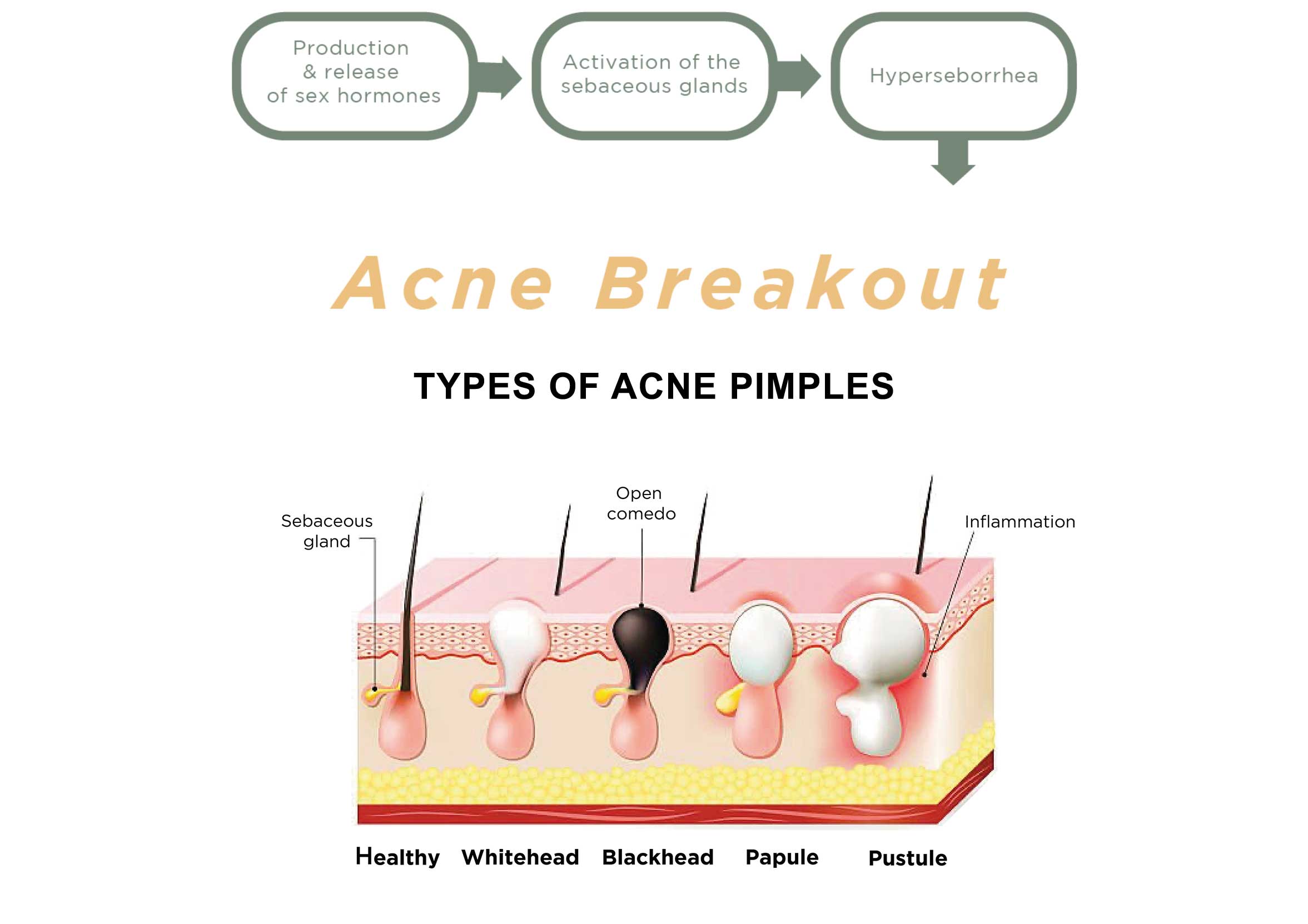 typesofacnepimples